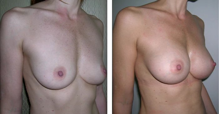 before & after photo of Liposuction