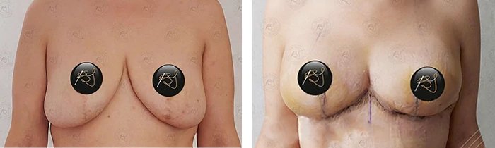 before & after photo of Tummy Tuck