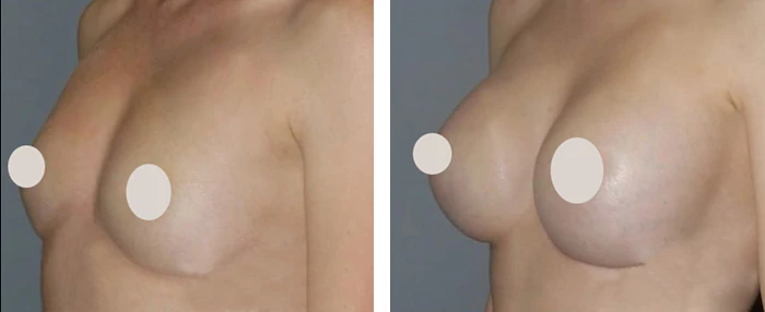 before & after photo of breast-augmentation