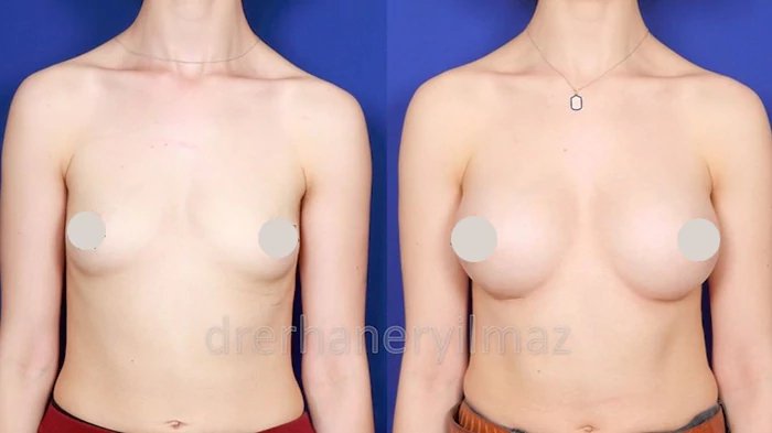 before & after photo of Breast Augmentation