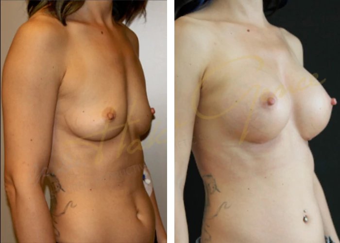 before & after photo of Breast Augmentation