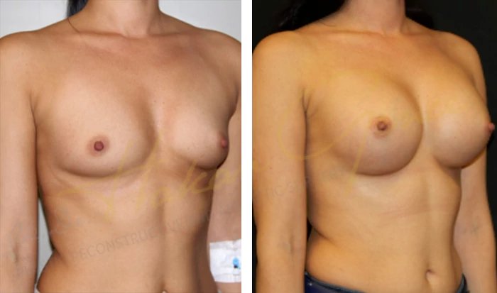 before & after photo of Breast Augmentation