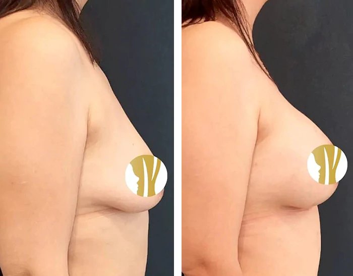 before & after photo of Breast Augmentation