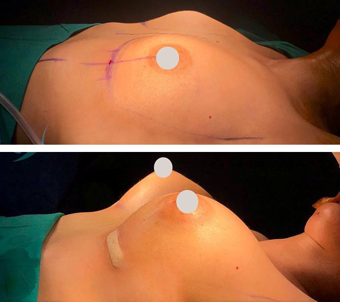 before & after photo of Abdominal Etching