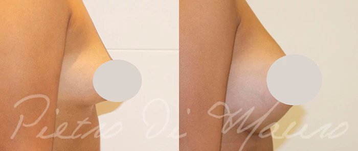 before & after photo of Breast Implants