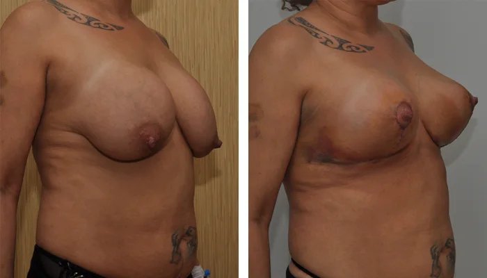 before & after photo of breast-implants-revision