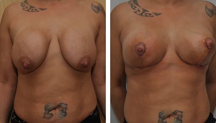 before & after photo of breast-implants-revision