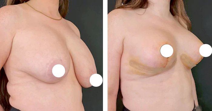 before & after photo of breast-implants-revision