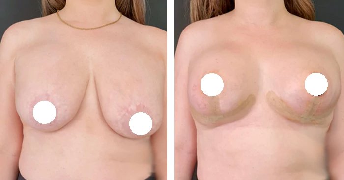 before & after photo of breast-implants-revision