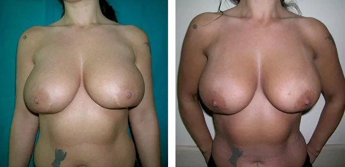 before & after photo of breast-implants-revision