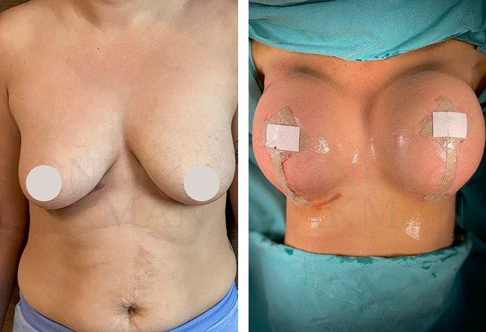 before & after photo of Breast Implants