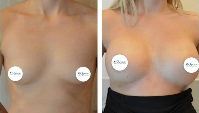 before & after photo of Tummy Tuck