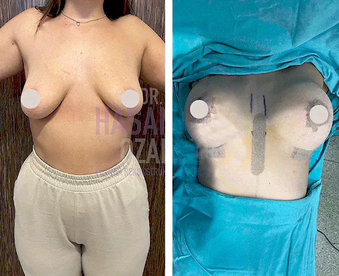 before & after photo of Brazilian Butt Lift