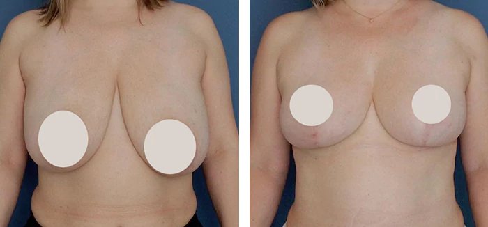 before & after photo of Liposuction