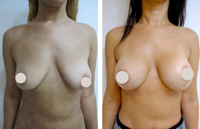 before & after photo of Liposuction