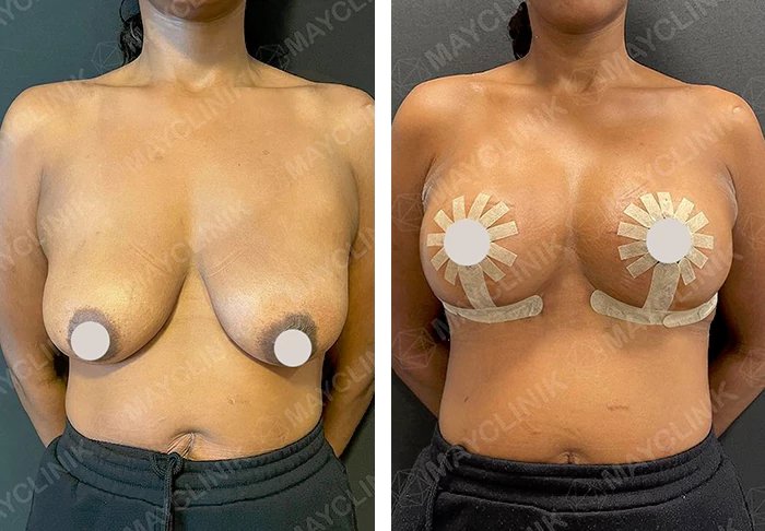 before & after photo of Tummy Tuck