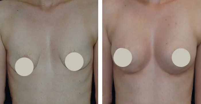 before & after photo of Breast Reconstruction Surgery