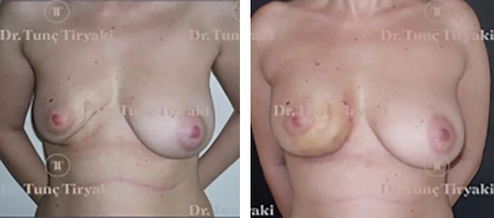 before & after photo of Breast Reconstruction Surgery