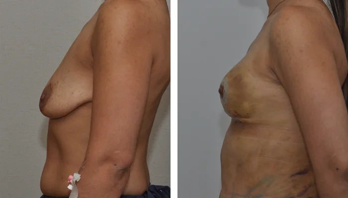before & after photo of Fat Transfer
