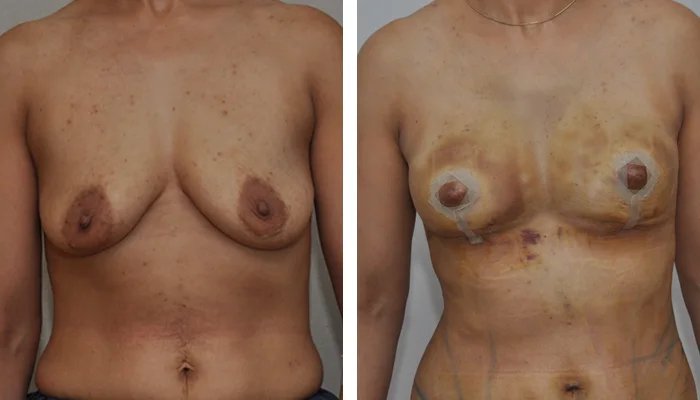 before & after photo of Fat Transfer