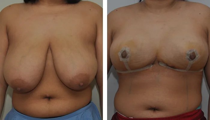 before & after photo of Tummy Tuck