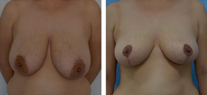 before & after photo of Breast Reduction