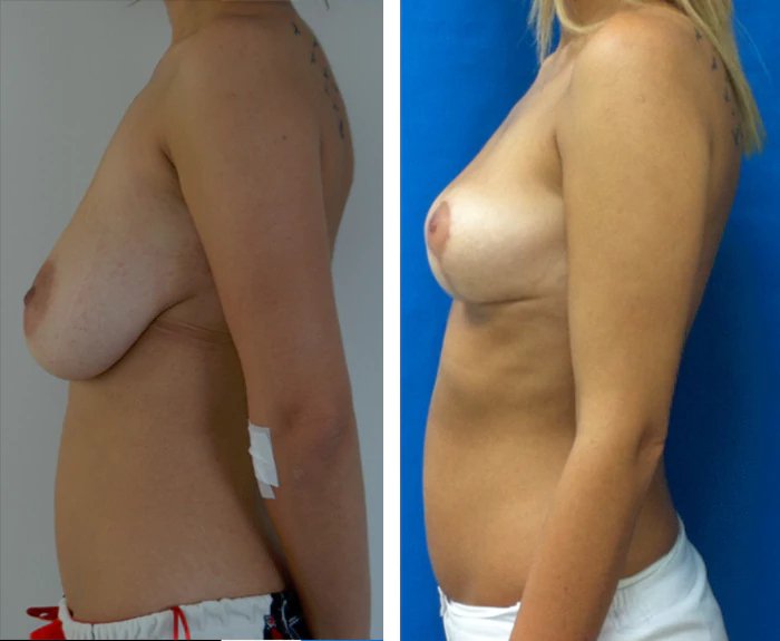 before & after photo of Breast Reduction