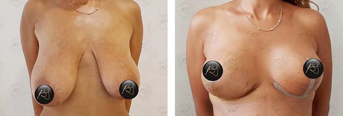 before & after photo of Tummy Tuck