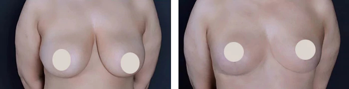 before & after photo of Liposuction