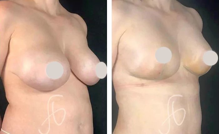 before & after photo of Tummy Tuck