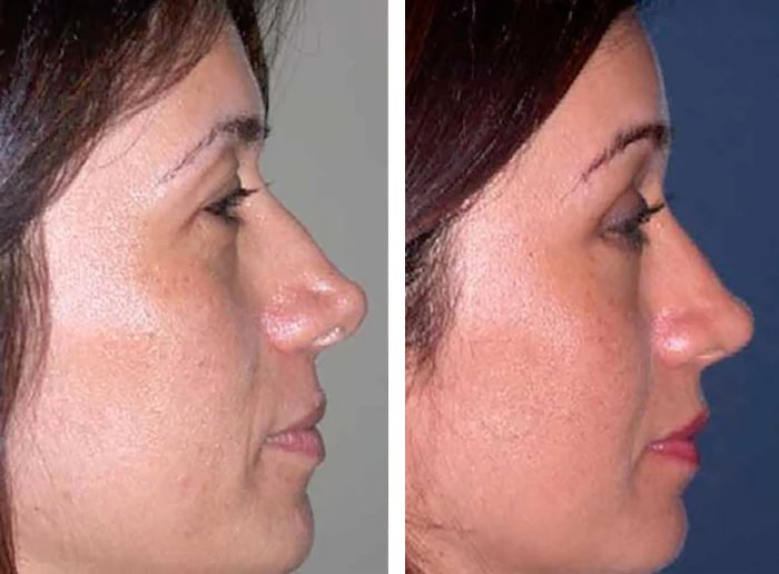 before & after photo of Rhinoplasty