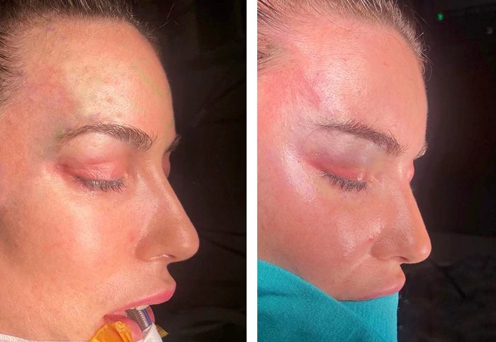 before & after photo of Rhinoplasty