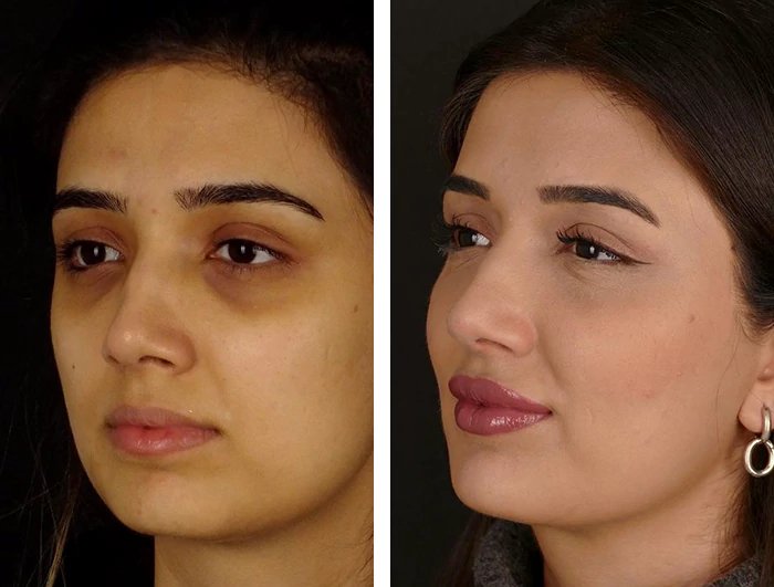 before & after photo of إزالة دهون الوجنة