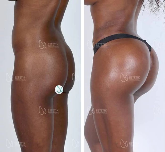 before & after photo of butt-implants