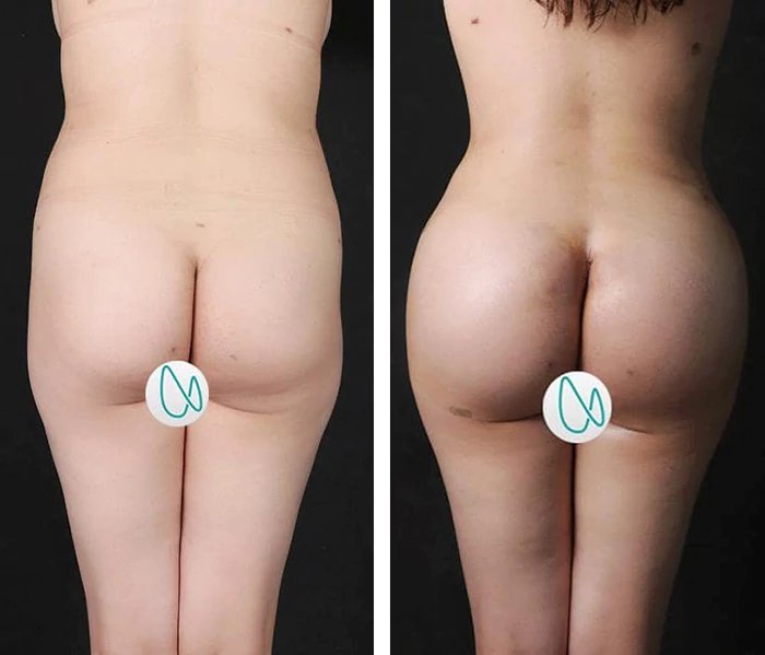 before & after photo of butt-implants