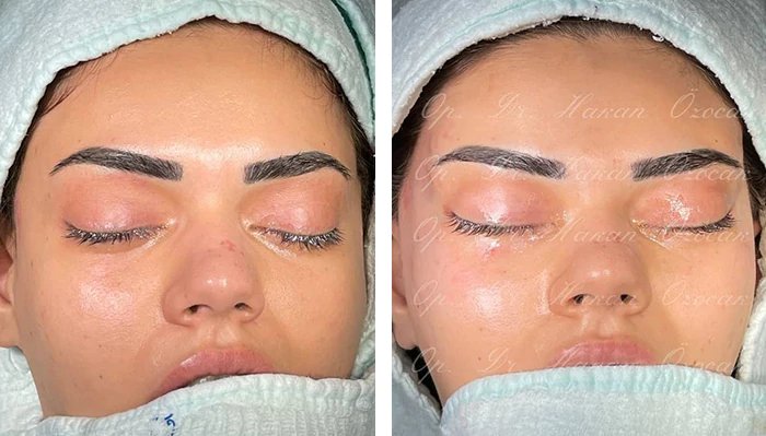 before & after photo of Cat Eye Surgery