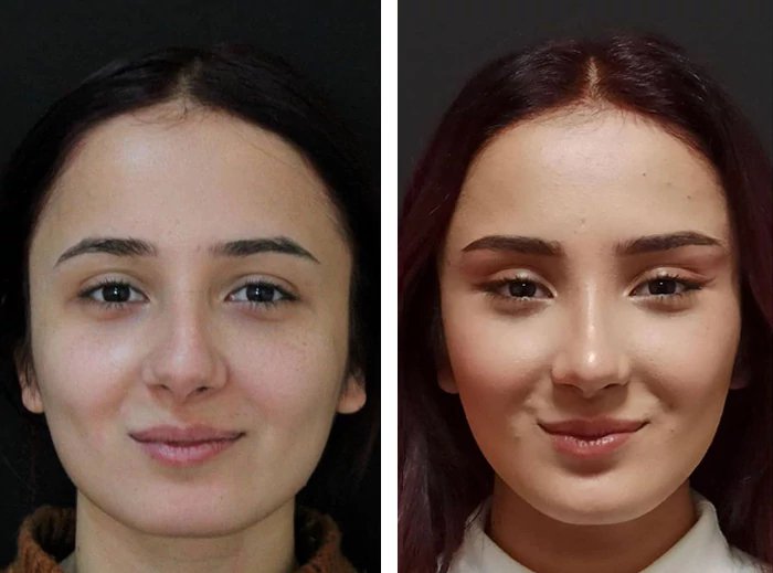 before & after photo of عملية عيون القطط