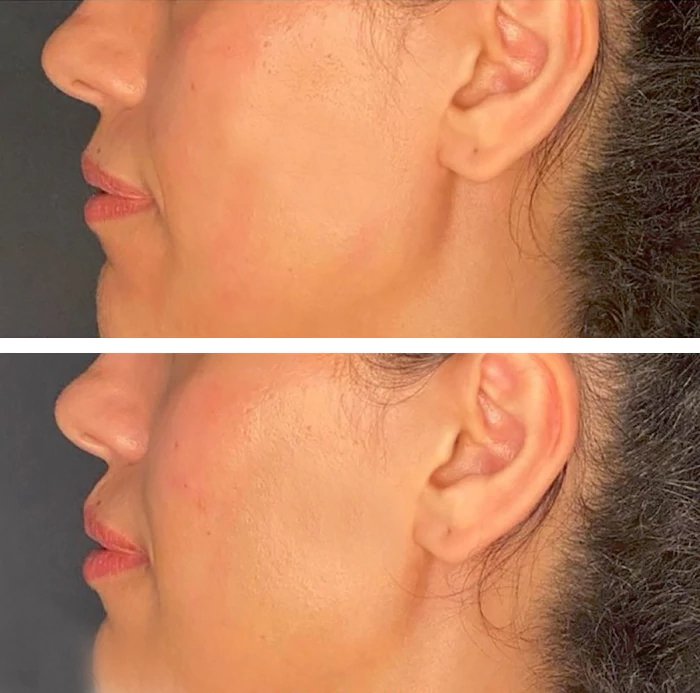 before & after photo of Cheek Lift