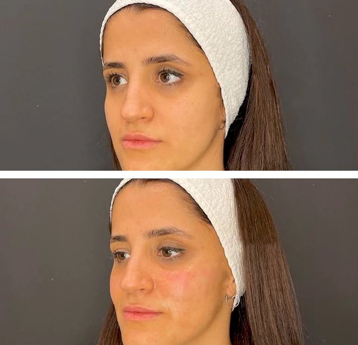 before & after photo of رفع الخدود