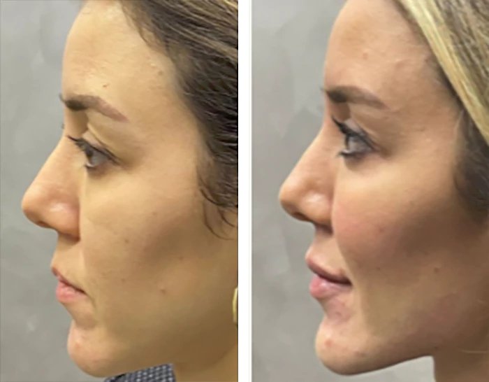 before & after photo of Cheek Filler