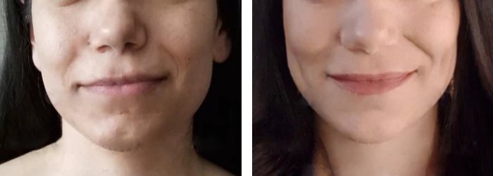 before & after photo of Cheek Lift