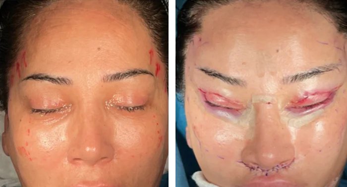 before & after photo of cheek-lift