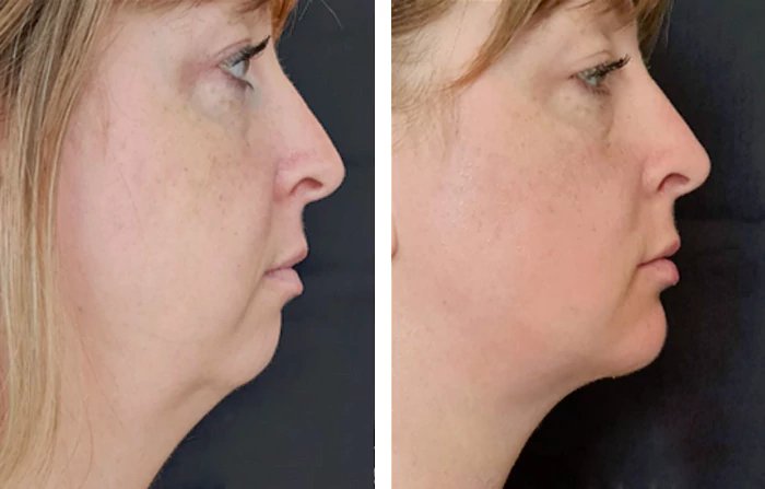 before & after photo of Chin Implants