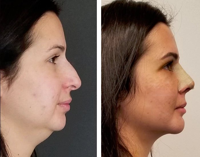 before & after photo of Chin Implants