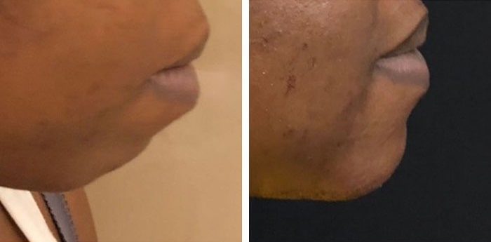 before & after photo of Chin Implants