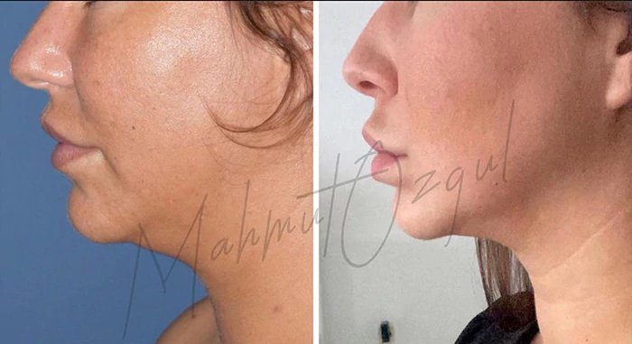 before & after photo of Rhinoplasty