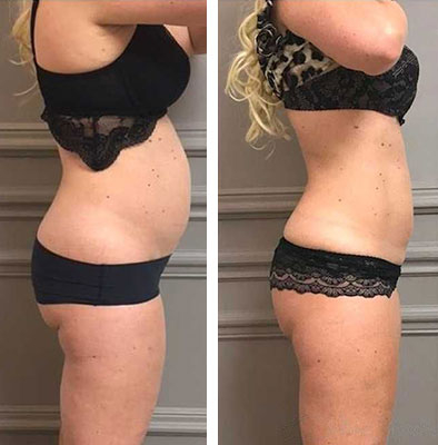 before & after photo of CoolSculpting