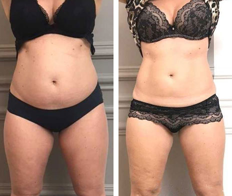 before & after photo of CoolSculpting