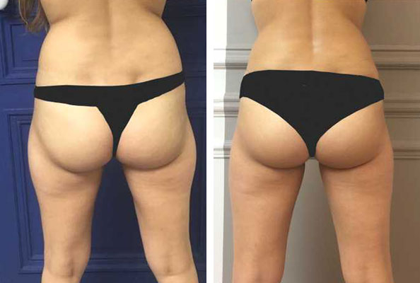 before & after photo of CoolSculpting