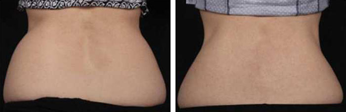 before & after photo of CoolSculpting